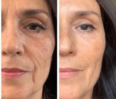 Botox Antes e Depois: Transformações e Cuidados