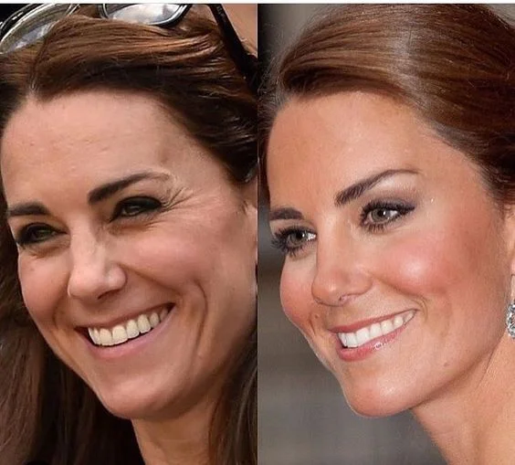 Botox Preventivo: Guia Completo para Você Botox Preventivo: Guia Completo para Você